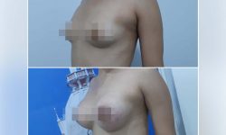 sm-breast-a1